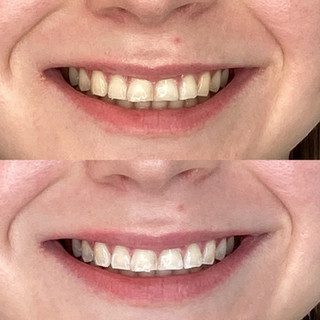 Before and After the treatment of Teeth Whitening at Flutter and Wink in Vancouver, Washington