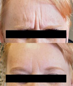 Before and After Botox Treatment at Flutter and Wink in Vancouver, Washington