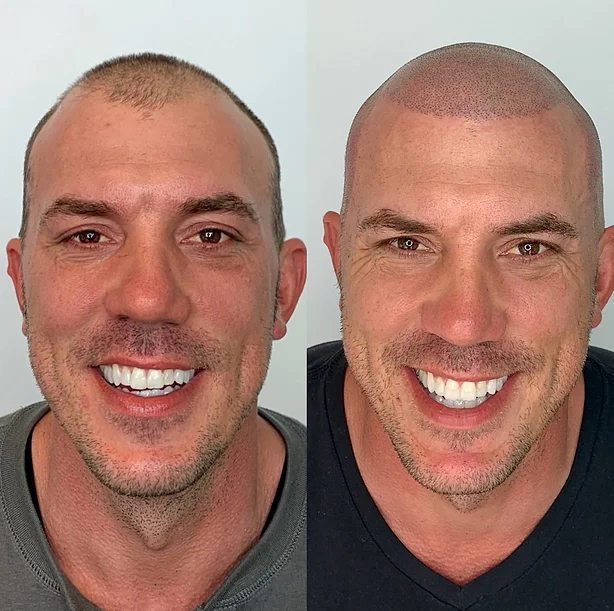 Before and After Scalp Micropigmentation (SMP) at Flutter and Wink in Vancouver, Washington