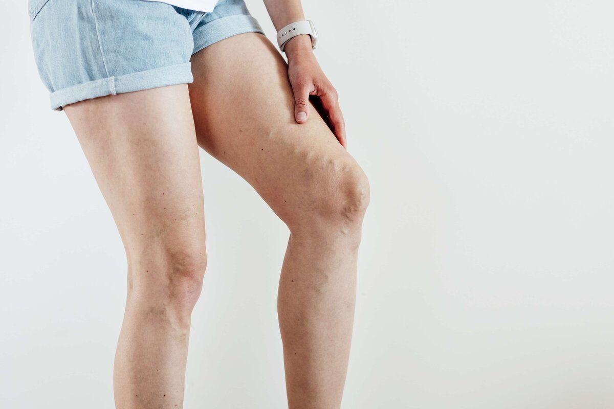 How Does Spider Vein Removal Work
