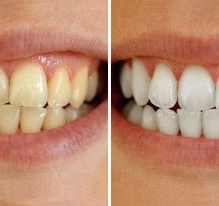 Before and After the treatment of Teeth Whitening at Flutter and Wink in Vancouver, Washington