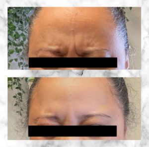 Before and After Botox Treatment at Flutter and Wink in Vancouver, Washington