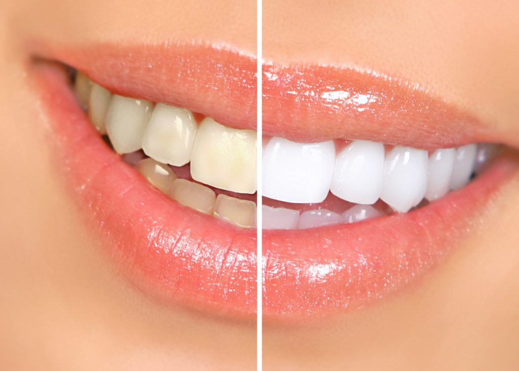 Before and After Teeth whitening treatment | Get Dental Grade Teeth Whitening at Flutter and Wink in Vancouver, Washington