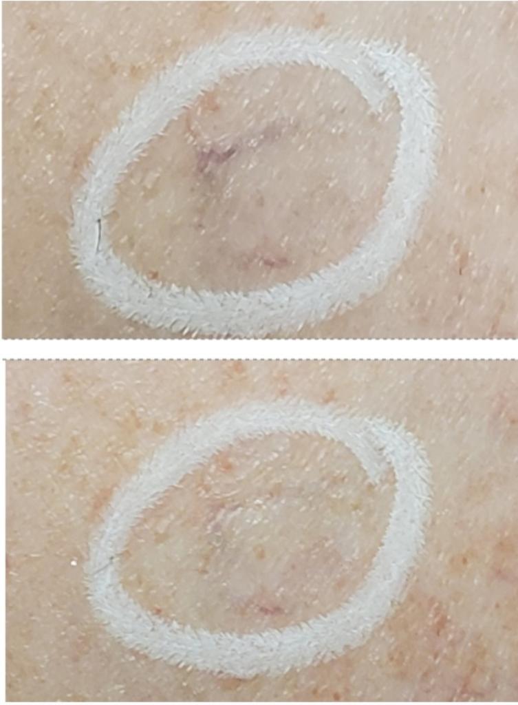 Before and After Spider Vein Removal Treatment at Flutter and Wink in Vancouver, Washington