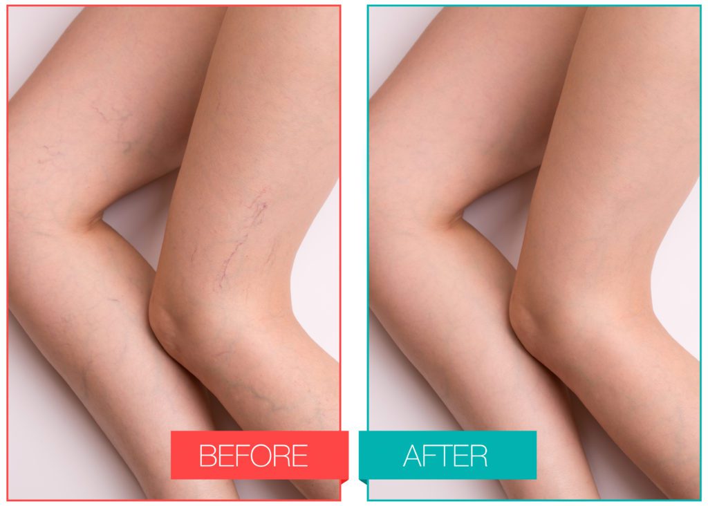 Before and After Spider Veins Removal treatment | Get Spider Vein Removal at Flutter and Wink in Vancouver, Washington