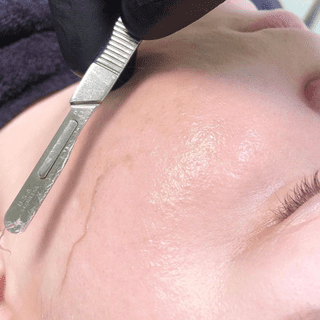 Woman getting Dermaplaning treatment at Flutter and Wink in Vancouver, Washington
