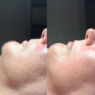 Before and After Dermaplaning treatment at Flutter and Wink in Vancouver, Washington
