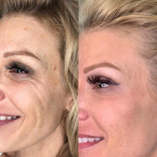 Before and After Jet Plasma Skin Tightening treatment at Flutter and Wink in Vancouver, Washington