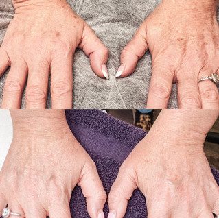 Before and After Jet Plasma Skin Tightening treatment at Flutter and Wink in Vancouver, Washington